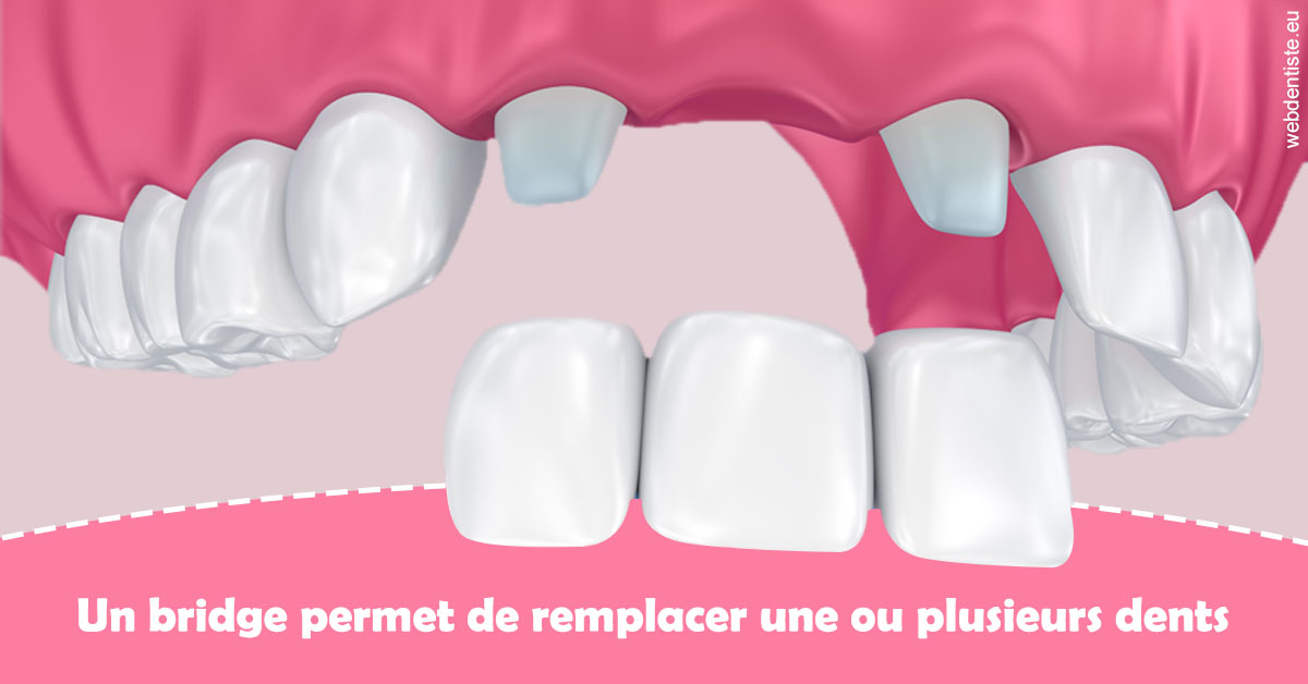 https://www.dr-christophe-carrere.fr/Bridge remplacer dents 2