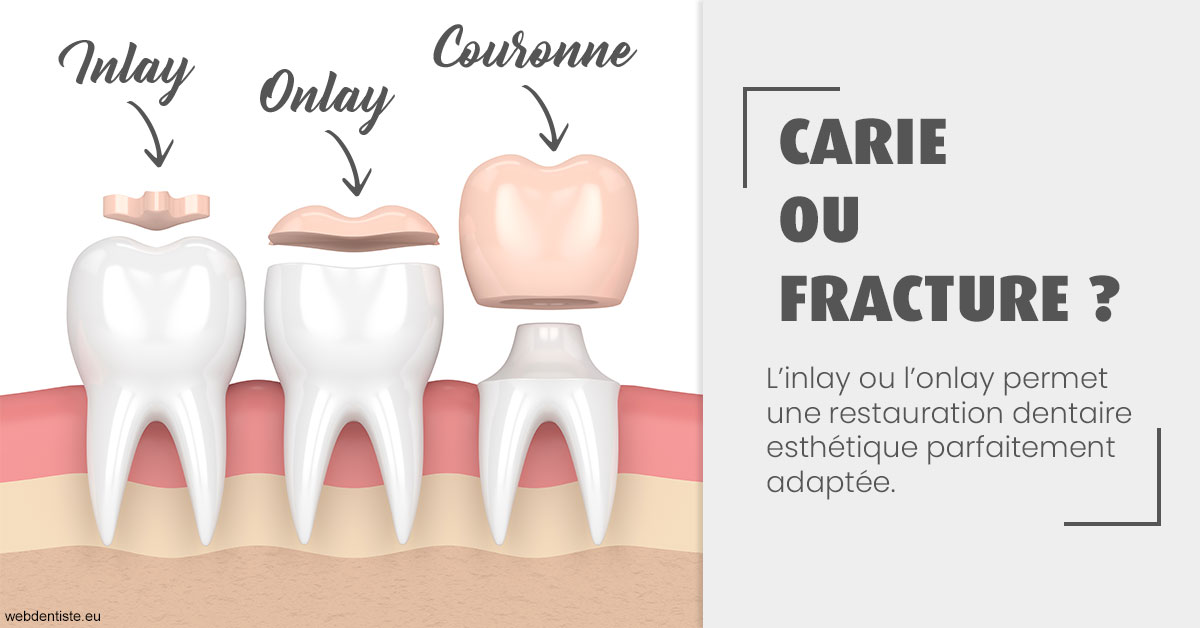 https://www.dr-christophe-carrere.fr/T2 2023 - Carie ou fracture 1