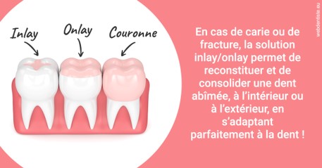 https://www.dr-christophe-carrere.fr/L'INLAY ou l'ONLAY 2