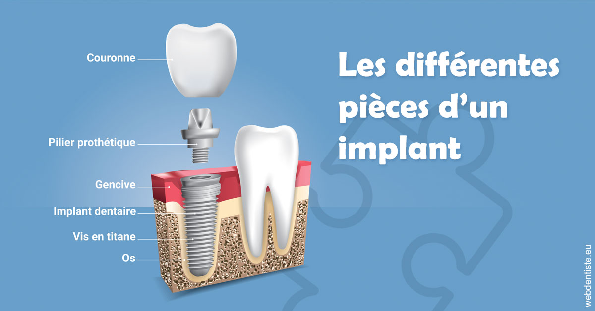 https://www.dr-christophe-carrere.fr/Les différentes pièces d’un implant 1